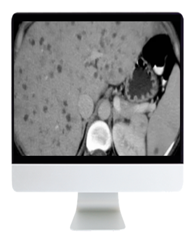 ARRS State of the Art Liver Imaging in Cirrhosis 2021