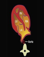 In this series, Dr. Tony Filly will be discussing the fetal heart and great vessels from the perspective of a general radiologist. The fetal heart is an area that tends to cause a lot of stress not to mention all the legal ramifications that come with cardiac anomalies.