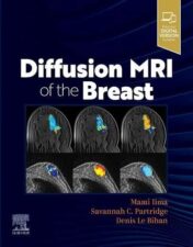 Diffusion weighted imaging (DWI) is a key emerging imaging modality for the management of patients with possible breast lesions, and Diffusion MRI of the Breast is the first book to focus on all aspects of DWI in today’s practice.