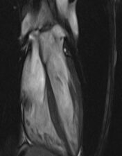 In this series Dr. Stefan Zimmerman discusses cardiac MRI of non-ischemic cardiomyopathy. Non-ischemic cardiomyopathy is a common cause of heart failure and MRI can be a vital tool in narrowing down the diagnosis. Dr. Zimmerman reviews the reasons these patients present to MRI, the most commonly encountered diagnoses in the non-ischemic category and the best approach for identifying disease. Program : Introduction to Cardiac MRI of Non-Ischemic Cardiomyopathy Non-Ischemic Cardiomyopathy Summary Cardiac Search Pattern in the Setting of Dilated Cardiomyopathy Dilated Cardiomyopathy HCM: Basal Septal with SAM HCM: Septal No SAM HCM: Apical HCM: Midcavity with Apical Aneurysm Restrictive Cardiomyopathy HCM: Severe Restrictive Cardiomyopathy Idiopathic Sarcoid: Acute Sarcoid: Chronic Myocarditis: Acute Myocarditis: Chronic Myocarditis: Toxic (Chemotherapy) ARVC Left sided ARVC/Arrhythmogenic Cardiomyopathy Athlete’s Heart Loeffler Endocarditis with Thrombus Amyloidosis: AL (MM) Amyloidosis: TTR Left Ventricular Non-Compaction:Typical LVNC: Focal Hemochromatosis Takotsubo Non-Ischemic Cardiomyopathy Conclusions
