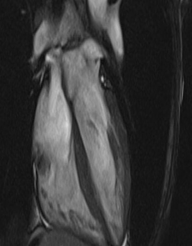 In this series Dr. Stefan Zimmerman discusses cardiac MRI of non-ischemic cardiomyopathy. Non-ischemic cardiomyopathy is a common cause of heart failure and MRI can be a vital tool in narrowing down the diagnosis. Dr. Zimmerman reviews the reasons these patients present to MRI, the most commonly encountered diagnoses in the non-ischemic category and the best approach for identifying disease. Program : Introduction to Cardiac MRI of Non-Ischemic Cardiomyopathy Non-Ischemic Cardiomyopathy Summary Cardiac Search Pattern in the Setting of Dilated Cardiomyopathy Dilated Cardiomyopathy HCM: Basal Septal with SAM HCM: Septal No SAM HCM: Apical HCM: Midcavity with Apical Aneurysm Restrictive Cardiomyopathy HCM: Severe Restrictive Cardiomyopathy Idiopathic Sarcoid: Acute Sarcoid: Chronic Myocarditis: Acute Myocarditis: Chronic Myocarditis: Toxic (Chemotherapy) ARVC Left sided ARVC/Arrhythmogenic Cardiomyopathy Athlete’s Heart Loeffler Endocarditis with Thrombus Amyloidosis: AL (MM) Amyloidosis: TTR Left Ventricular Non-Compaction:Typical LVNC: Focal Hemochromatosis Takotsubo Non-Ischemic Cardiomyopathy Conclusions