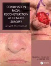 Combination Facial Reconstruction after Mohs Surgery: A Case Based Atlas (Original PDF