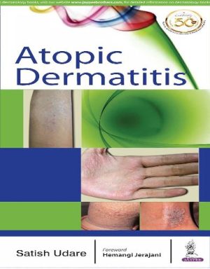 Atopic Dermatitis Original PDF 2018