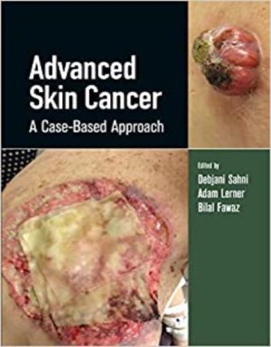 Advanced Skin Cancer: A Case-Based Approach Original pdf 2022